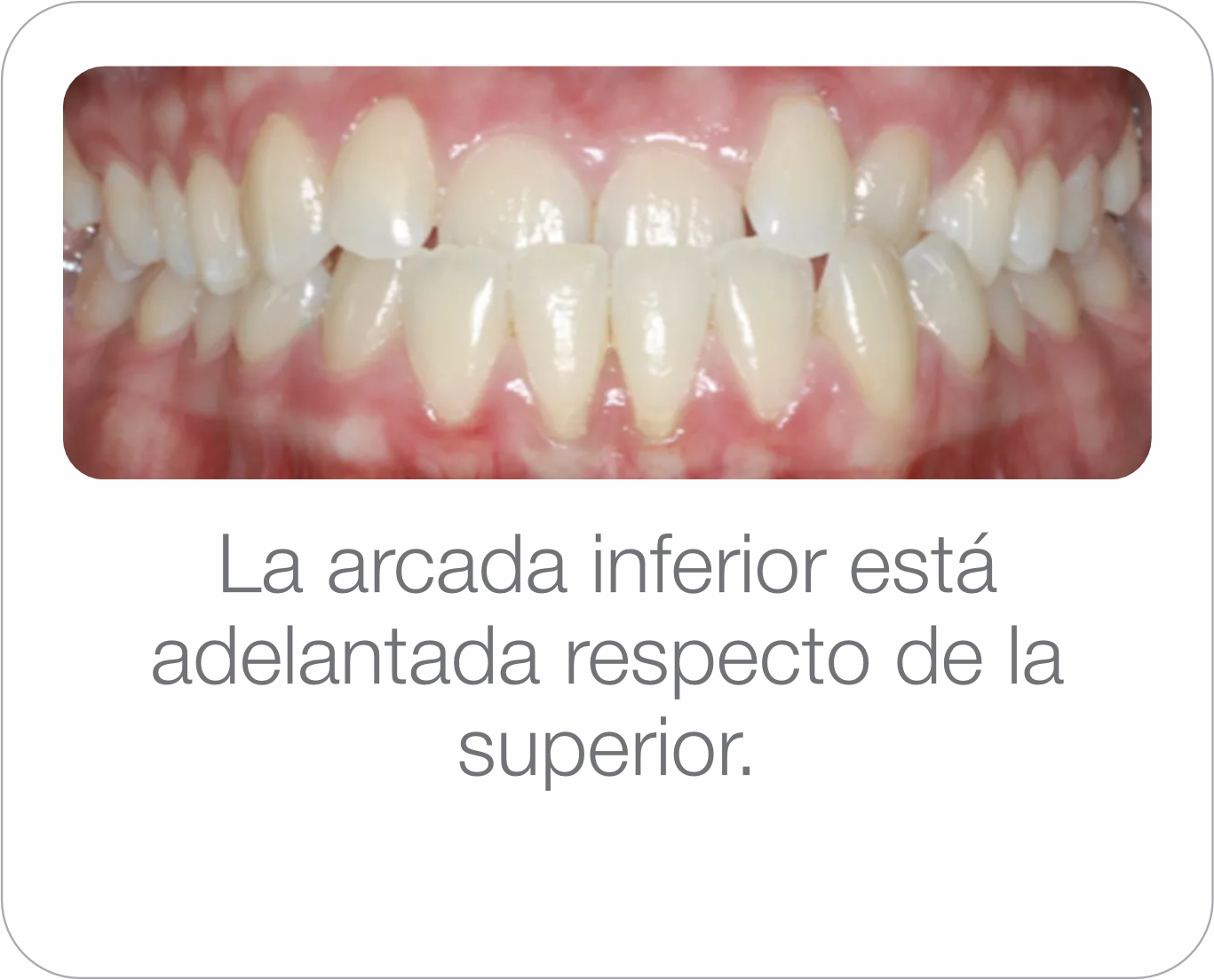 Caso real - Prognatismo